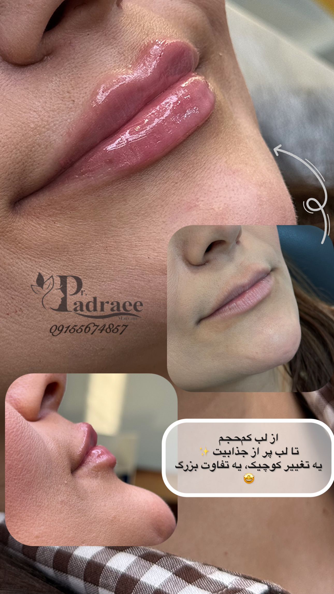 فیلر لب (7)