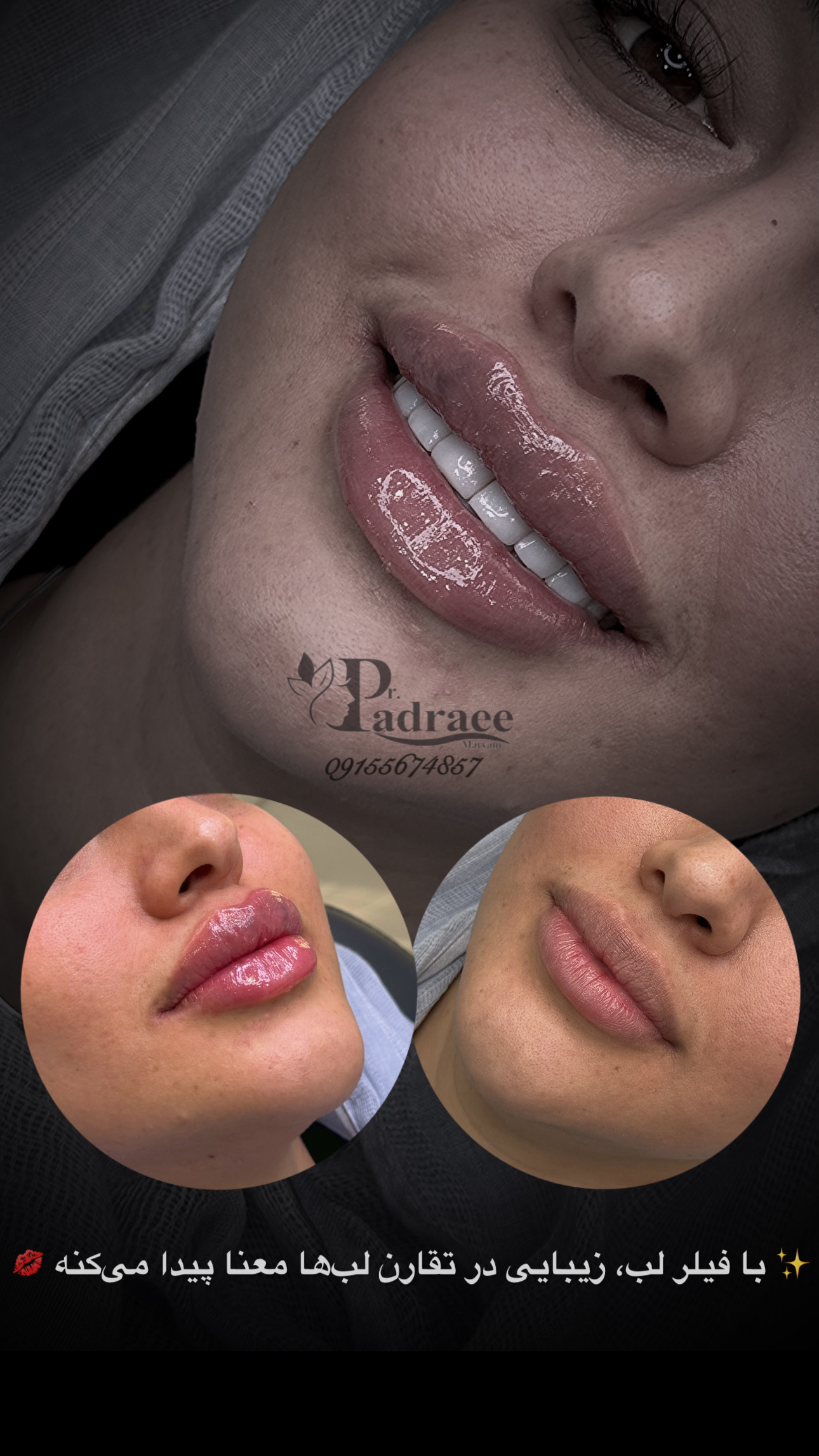 فیلر لب (8)